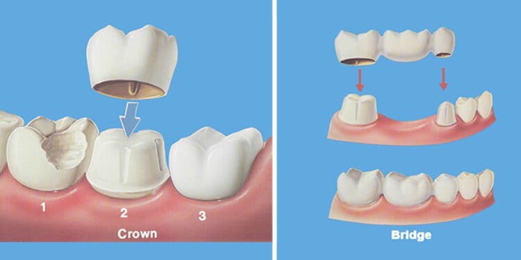 Crowns and Bridges